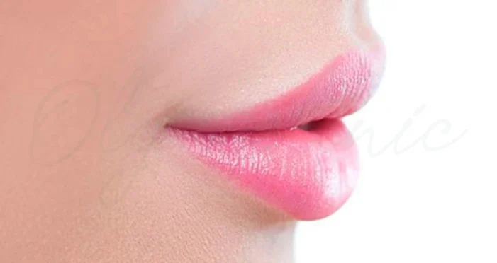 تزریق ژل لب مدل قلبی: فرم دخترانه و طبیعی لب‌ها