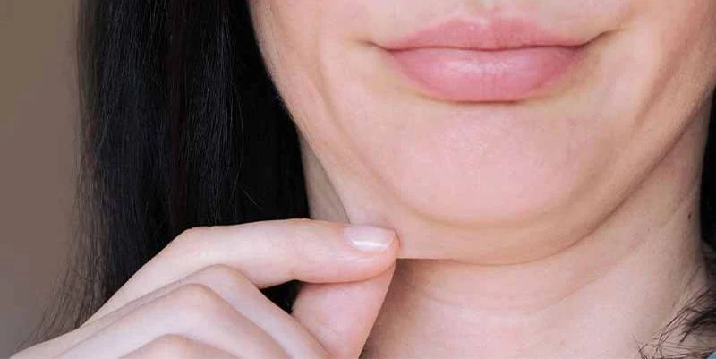 مزوتراپی | هایفوتراپی شل شدن پوست بعد از ساکشن غبغب